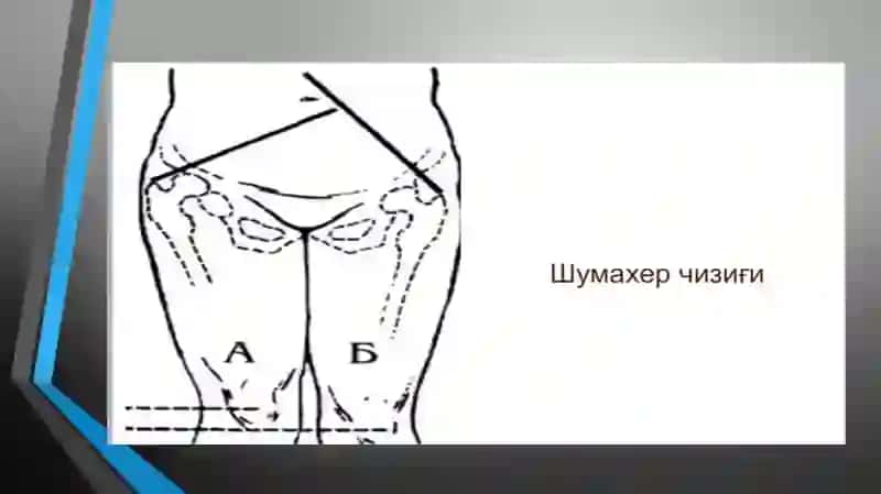 Son suyagi chiqishi. sinishi jaroxatlari 4