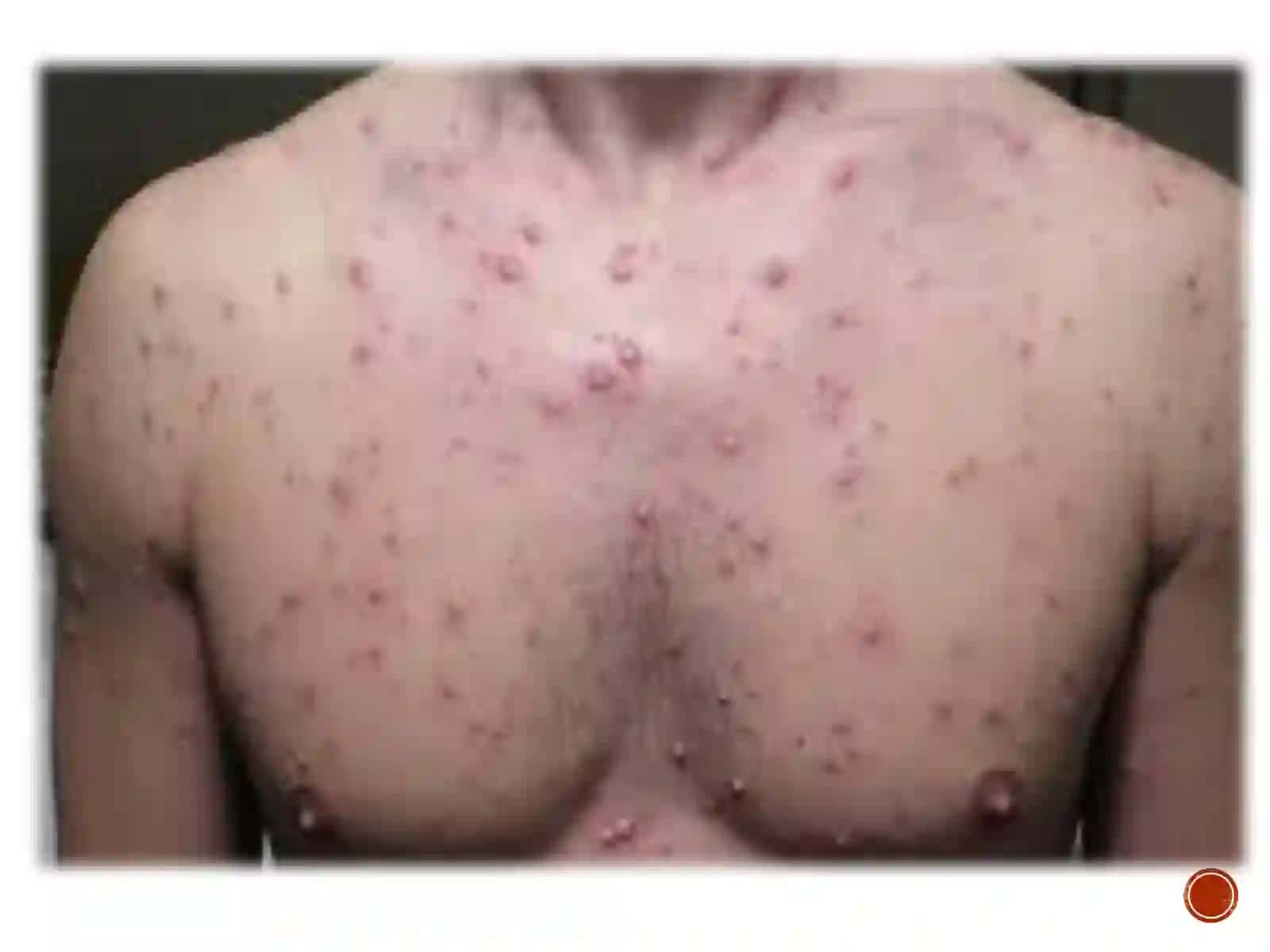 Gerpesvirusi qo‘zg‘atgan infeksiya 4