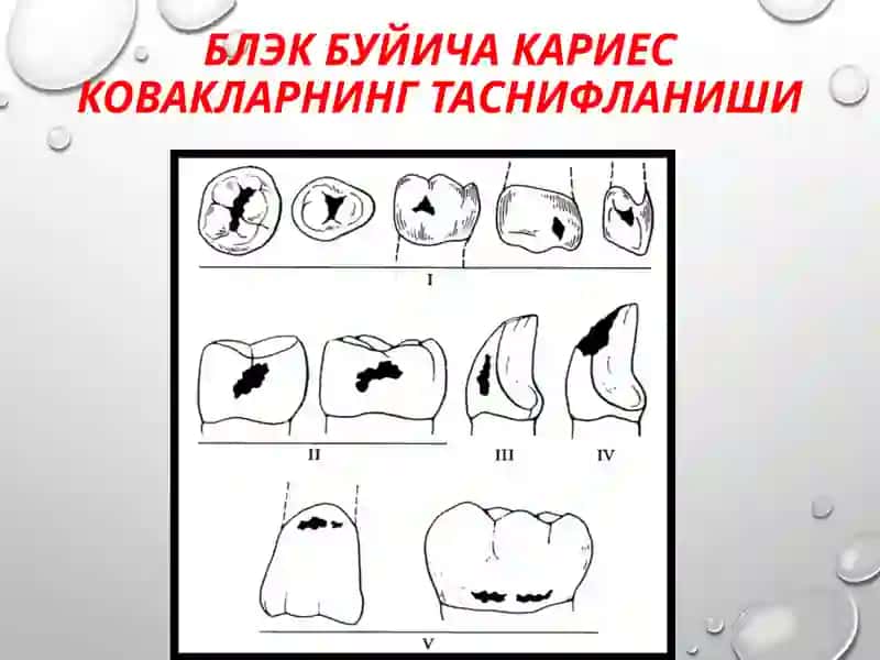 IIсинфкариозбушликлариничархлашвапломбалаш 4