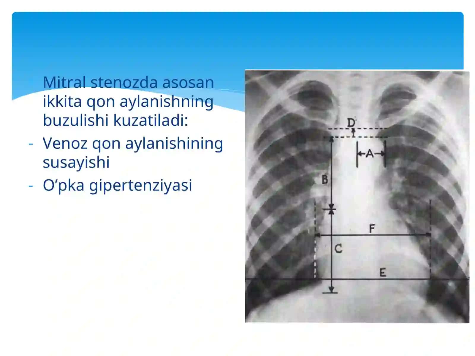 YURAKNING MITRAL POROGI VA STENOZI 4