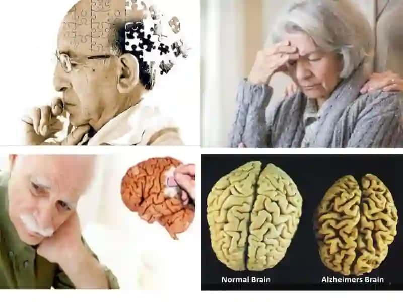 Alzheimer's disease 4