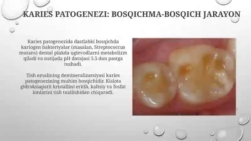 Kariesning etiologiyasi 4