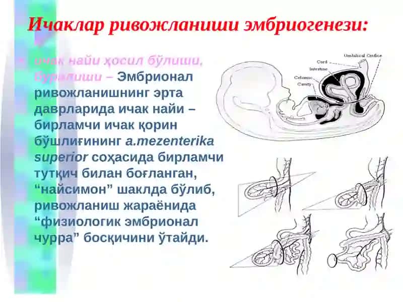 Болаларда туғма ичак тутилишлари 4