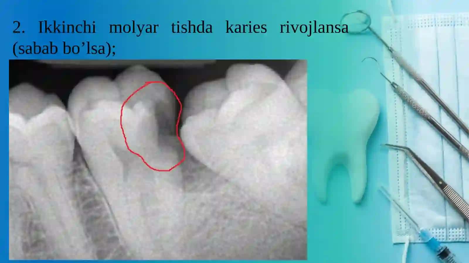 Uchinchi molyar tishlarni olishga ko’rsatma va olish usullari 4