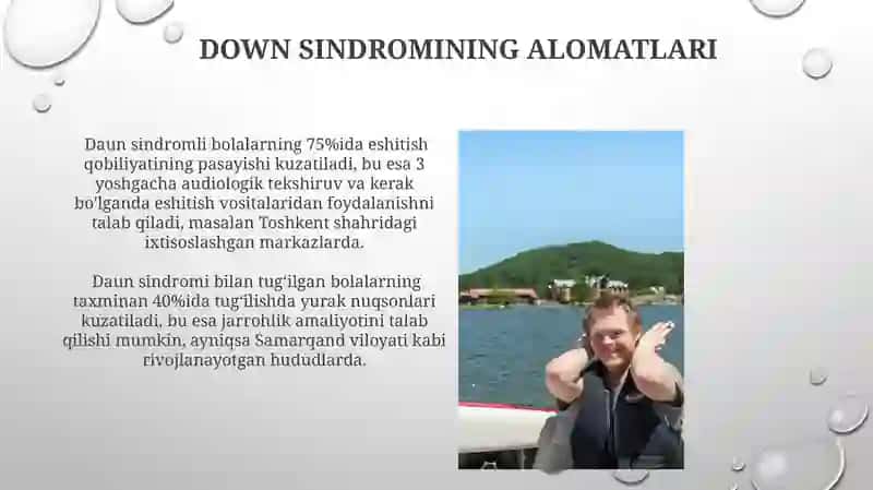 Daun sindromi haqida 4