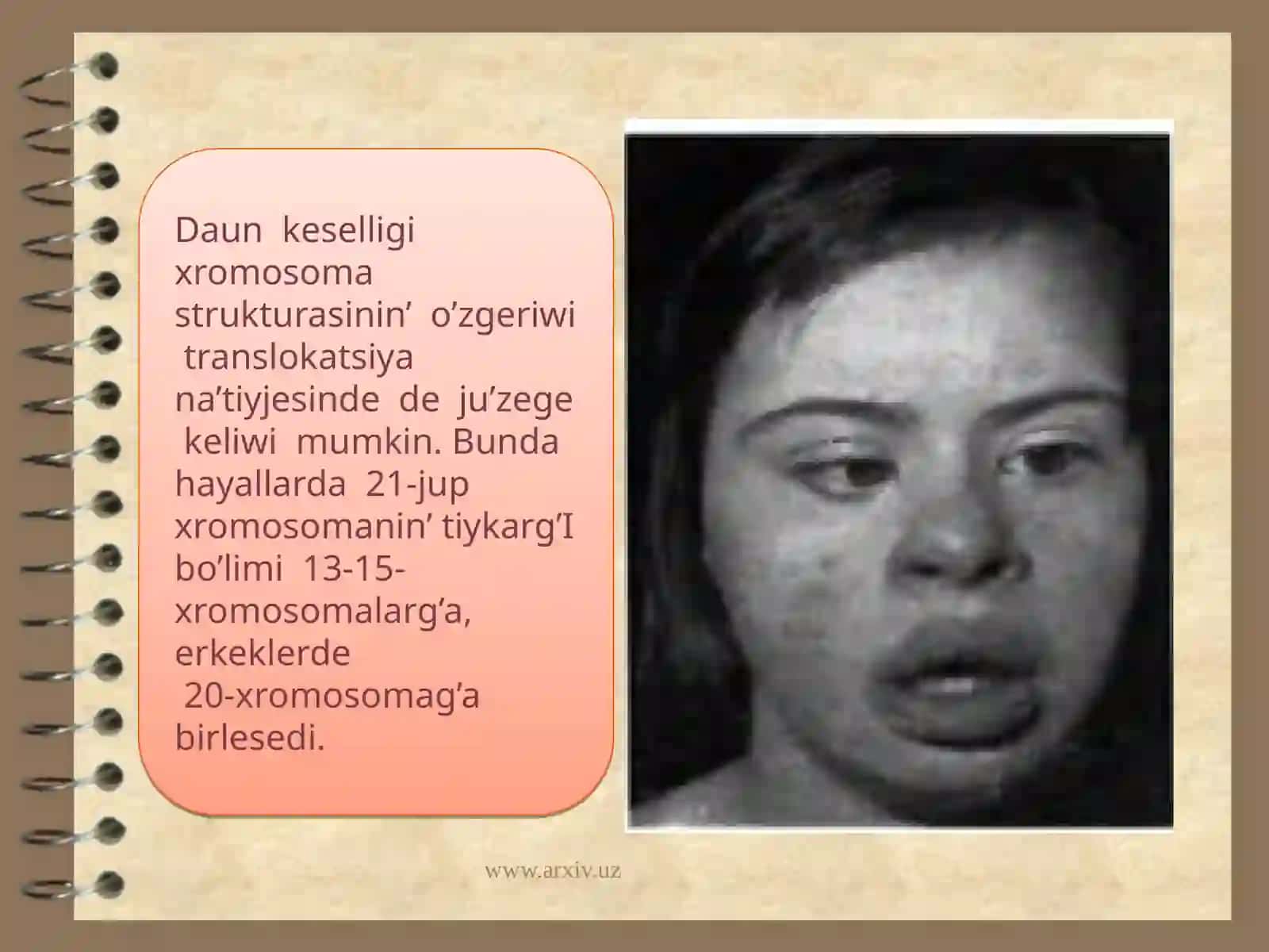 Xromosoma kesellikleri, Daun sindromi 4