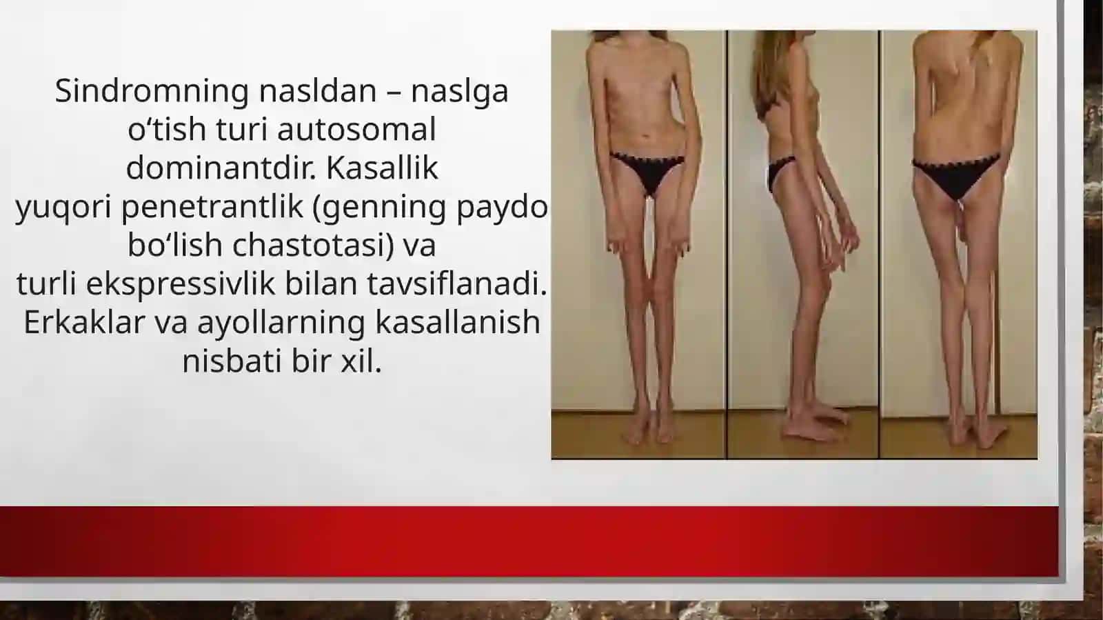 MARFAN SINDROMI 4