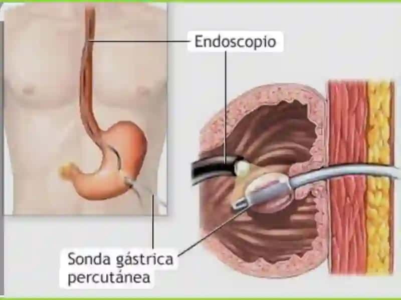 Gastrostomiya 4
