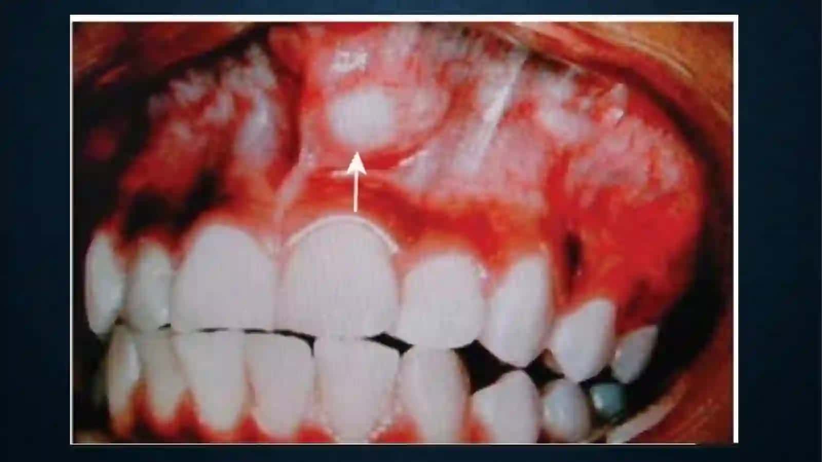 SO’LAK BEZLARI O’SMALARI. MONOMORF ADENOMA, POLIMORF ADENOMA, MUKOEPIDERMOID O’SMA 4