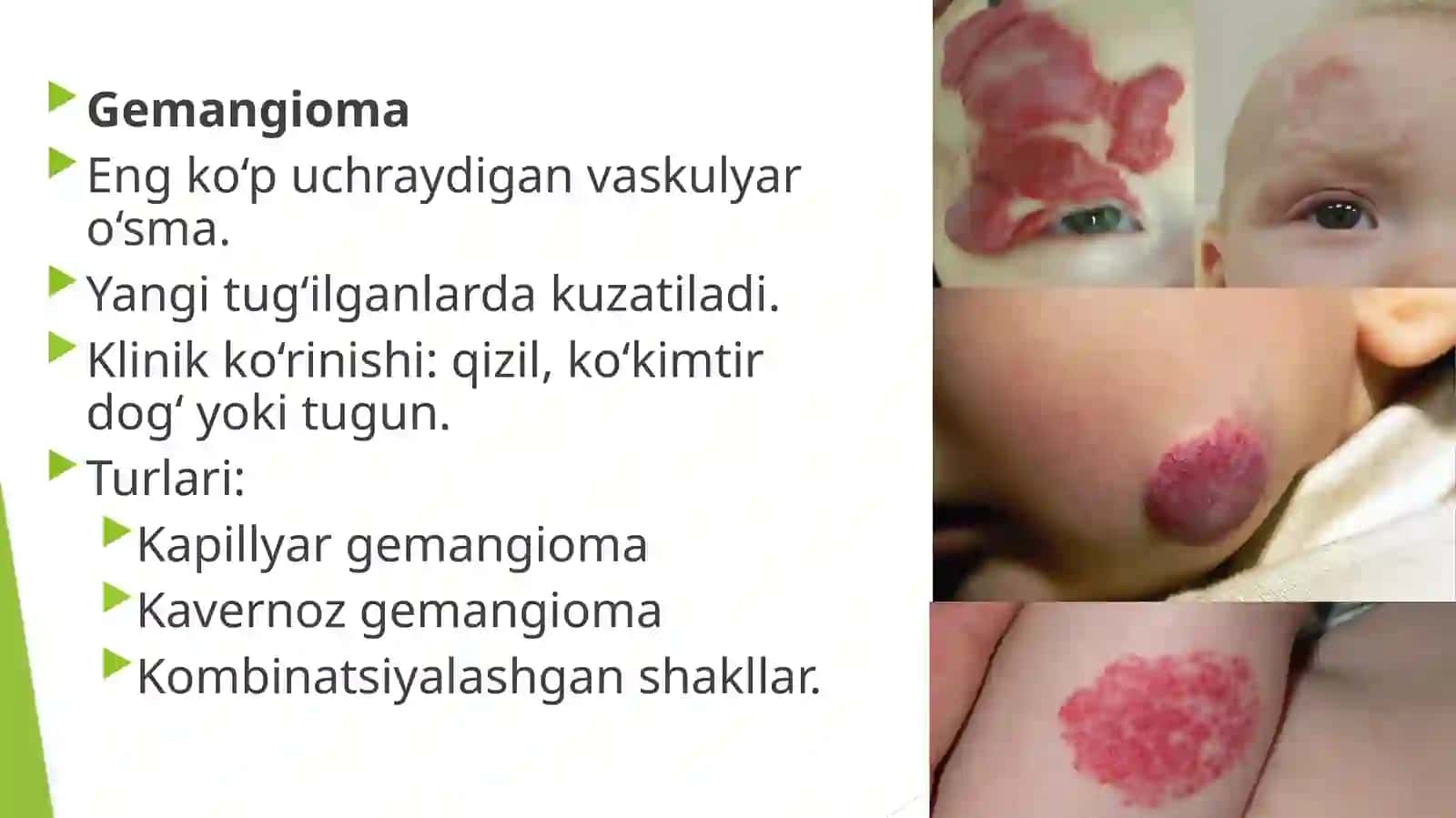 Tomirósmalari, angiomalar 4