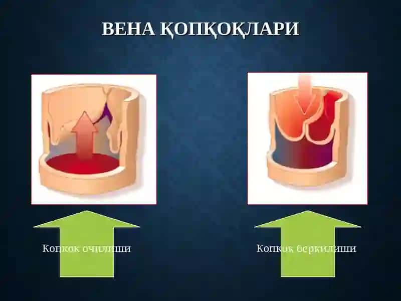 Оyoq venalarini varikoz kasalligi 4
