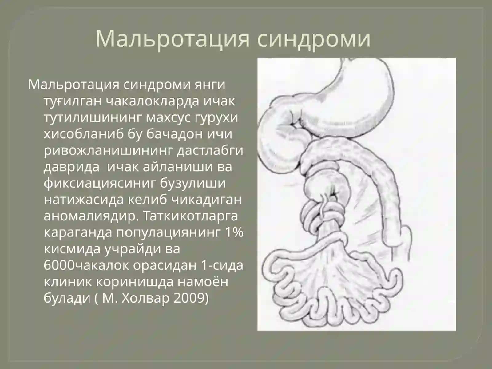 Туғма ичак тутилишлари 4