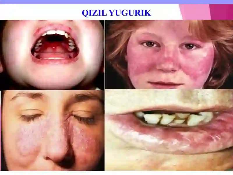 Tizimli Qizil Bo`richa 4