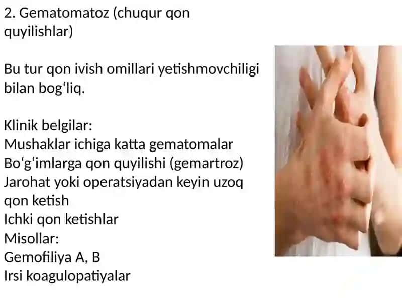 Gemorragik diatezlarning ko‘rinishlari 4