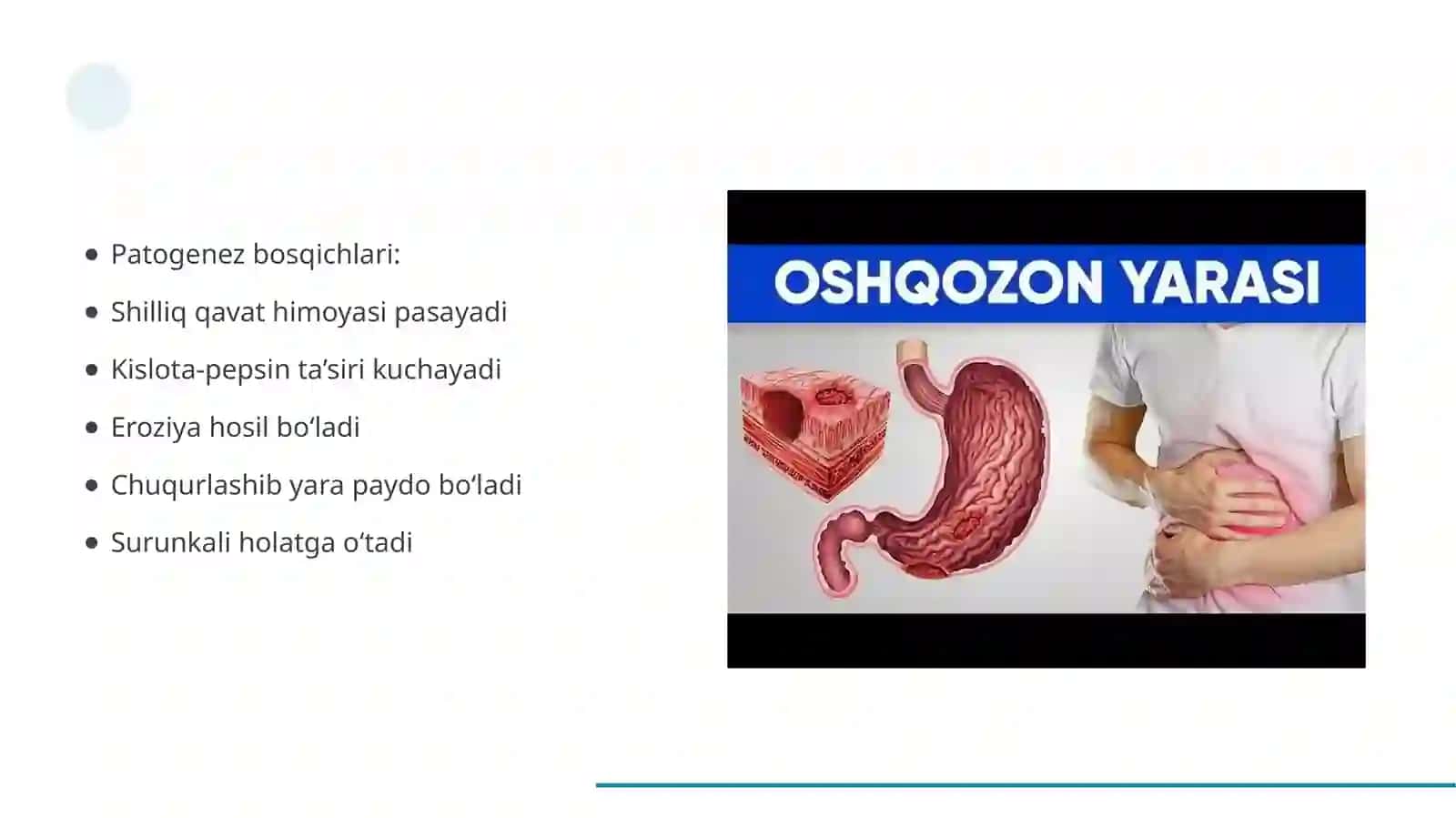 Oshqozon yara kasalligi etiopatogenezi 4