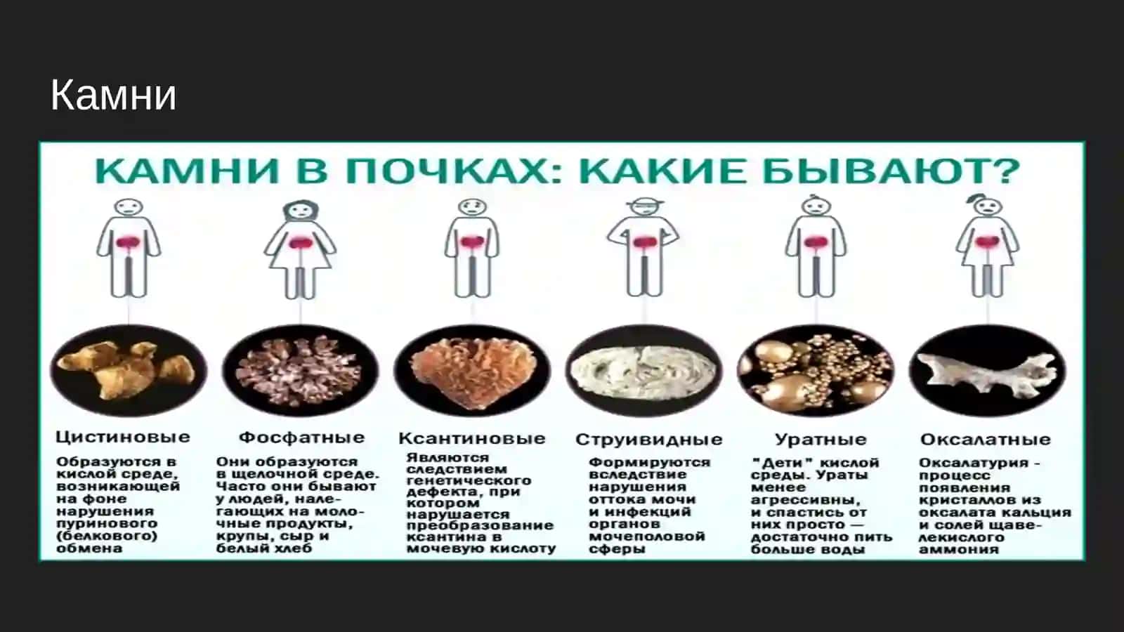 Нефролитиаз (камни в почках) 4