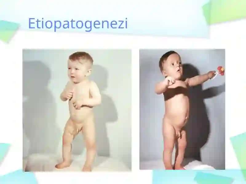 RAXITSIMON KASALLIK GIPERVITAMINOZ- D 4