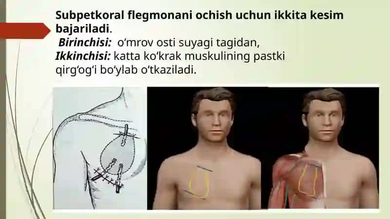 Subpektoralf flegmona 4