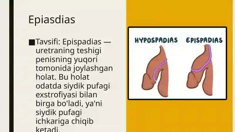Uretra va moyaklar tug'ma nuqsonlari 4