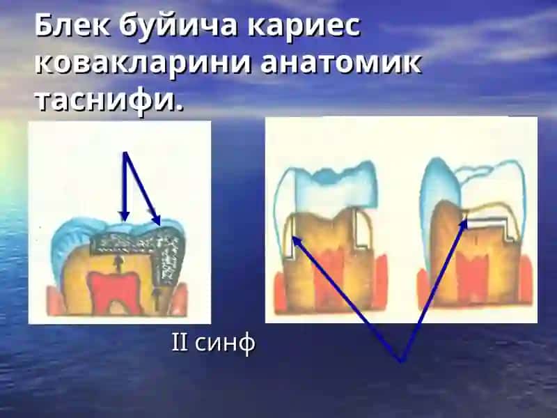 Кариес ковакни чархлаш босқичлари ва услублари 4