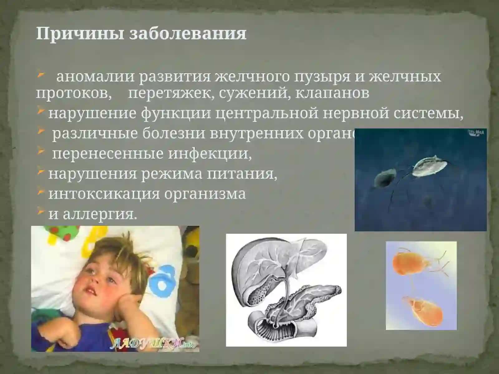 Дискинезия желчевыводящих путей у детей 4