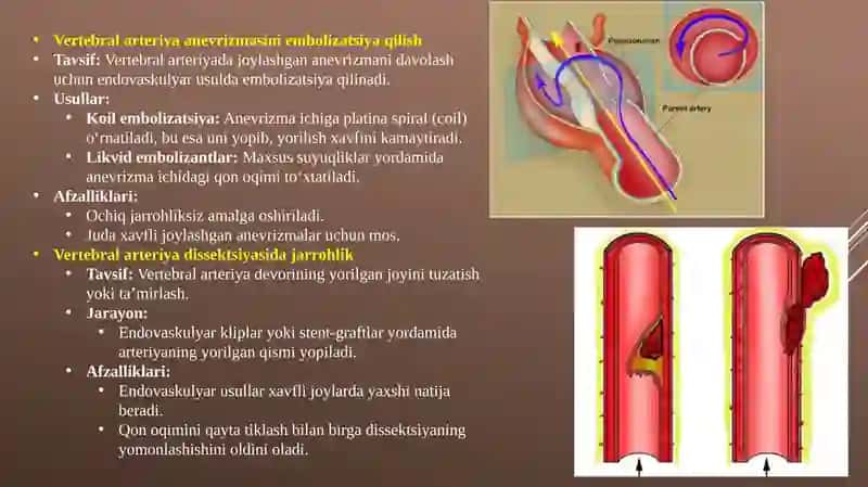 Vertebralarteriya operatsiyasi 4