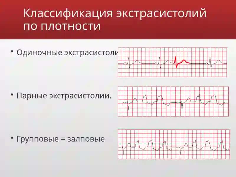 Ekstrasistoliya 4