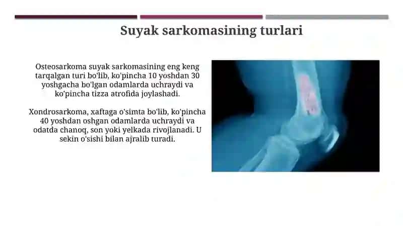 Suyaksarkomasi 4