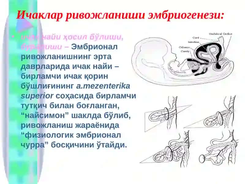 Болаларда туғма ичак тутилишлари 4