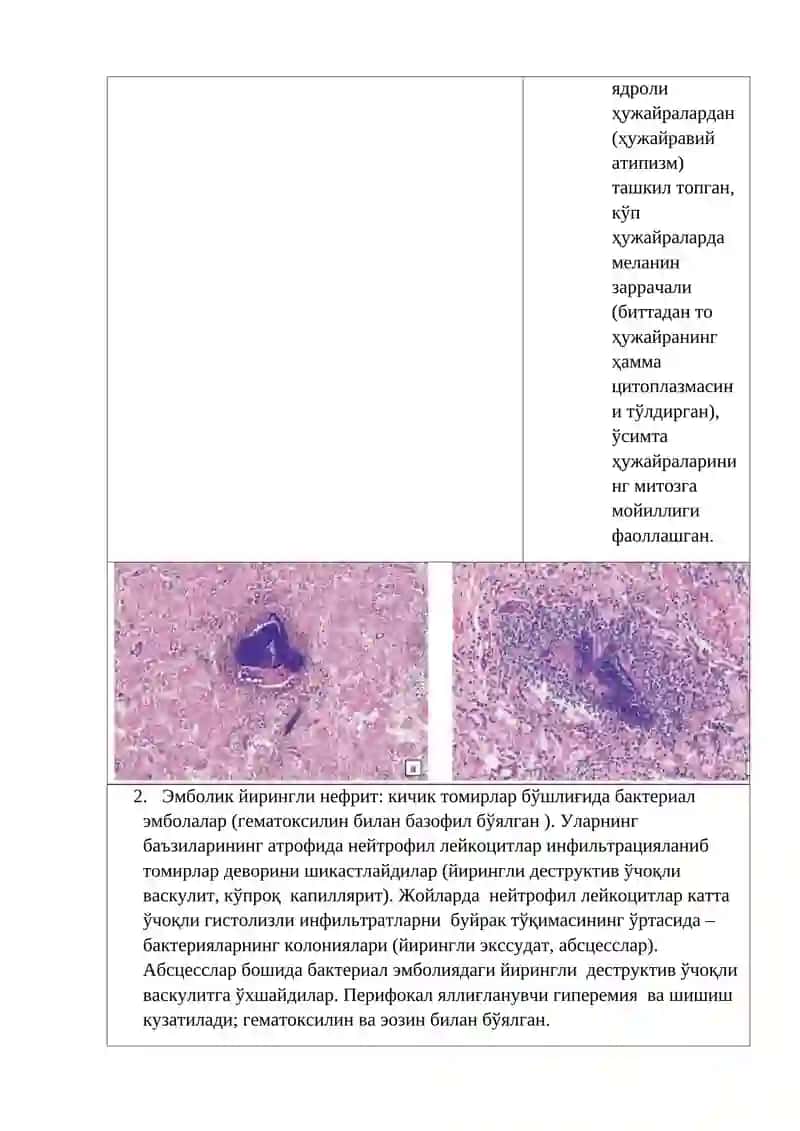 Тромбоз, Эмболия ва Инфаркт 4