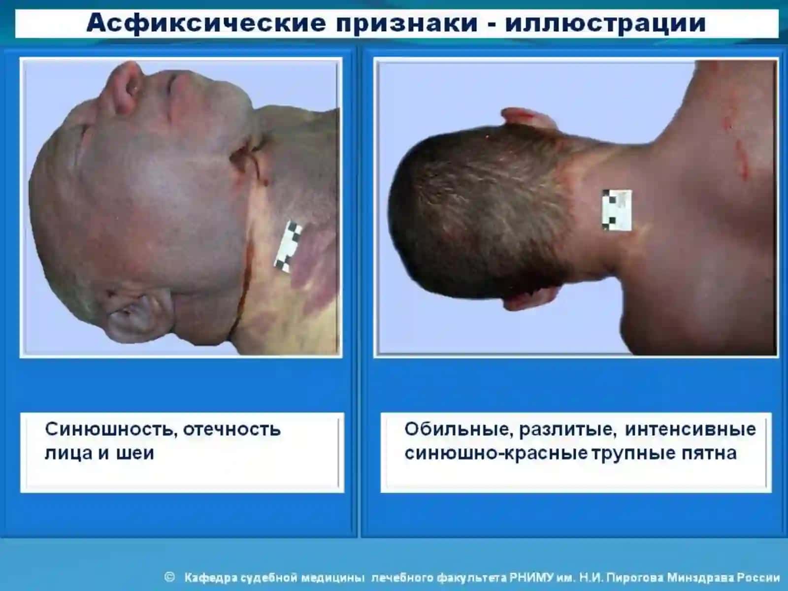 Асфиксические признаки - иллюстрации 4