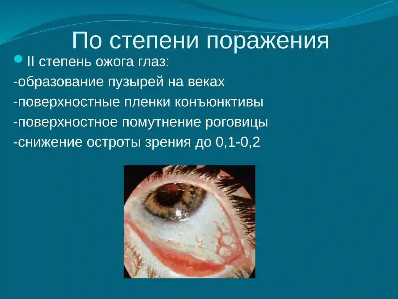 Ожоги глаз 4