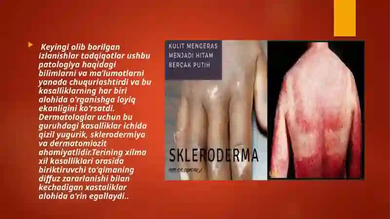 Kollagenozlar 4