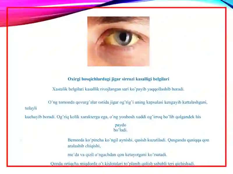 Surunkali gepatit Jigar sirrozi 4