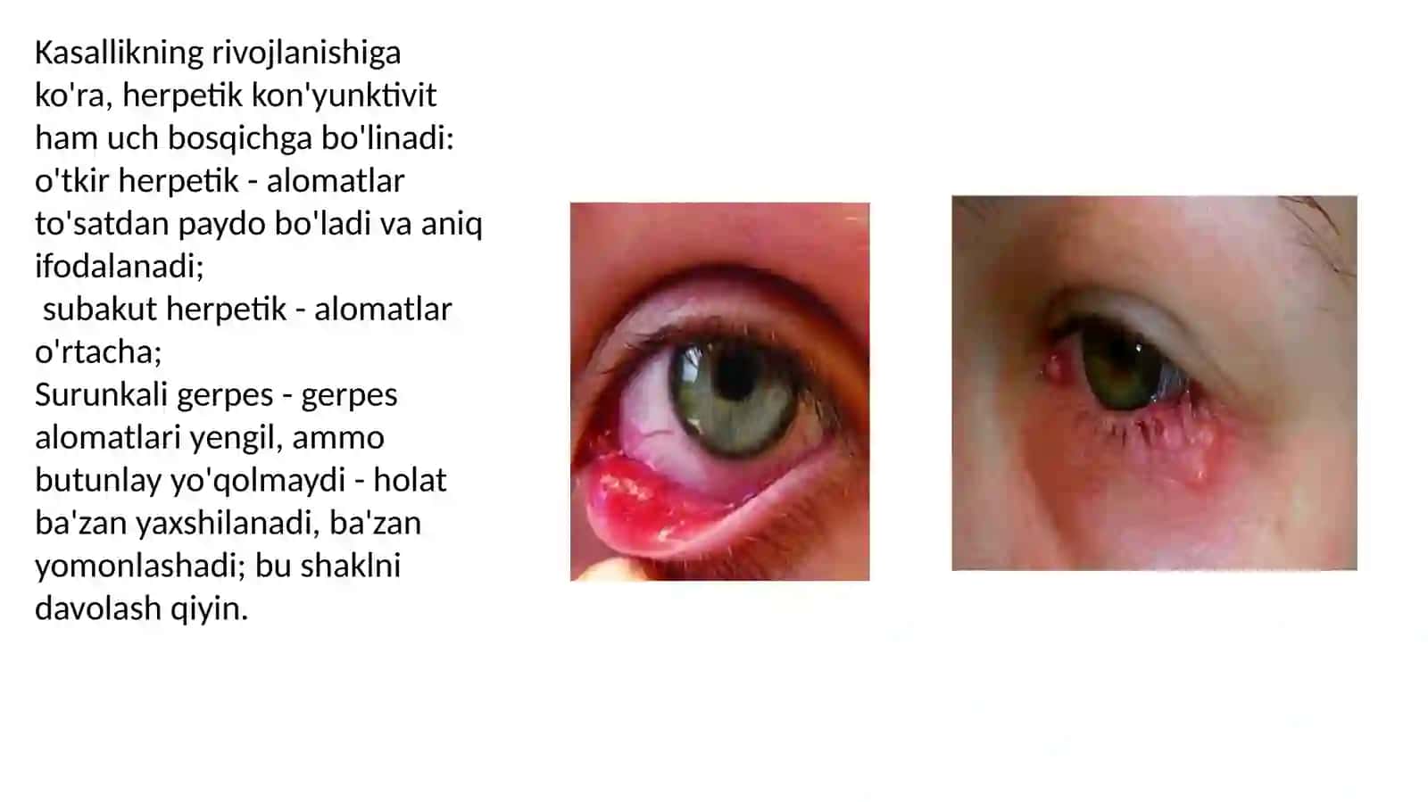 Gerpetikkonyunktivit 4
