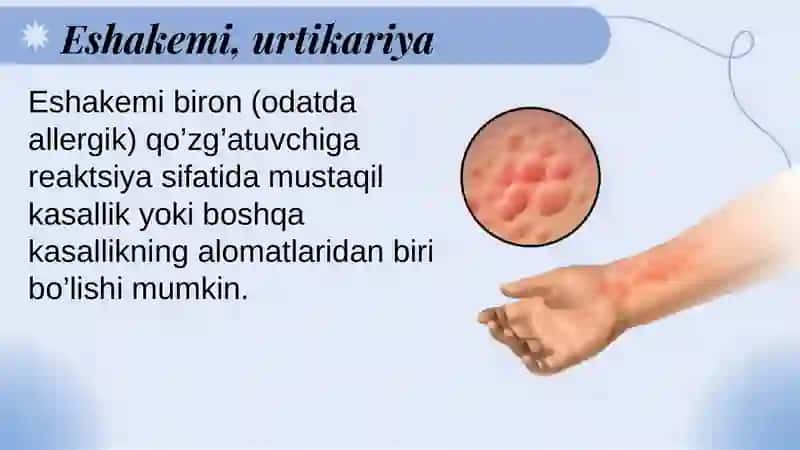 Eshakemi-urtikariya 4