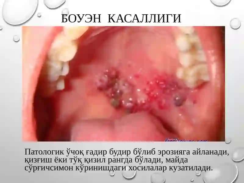 Стооматология саратонолди касалликлари 4