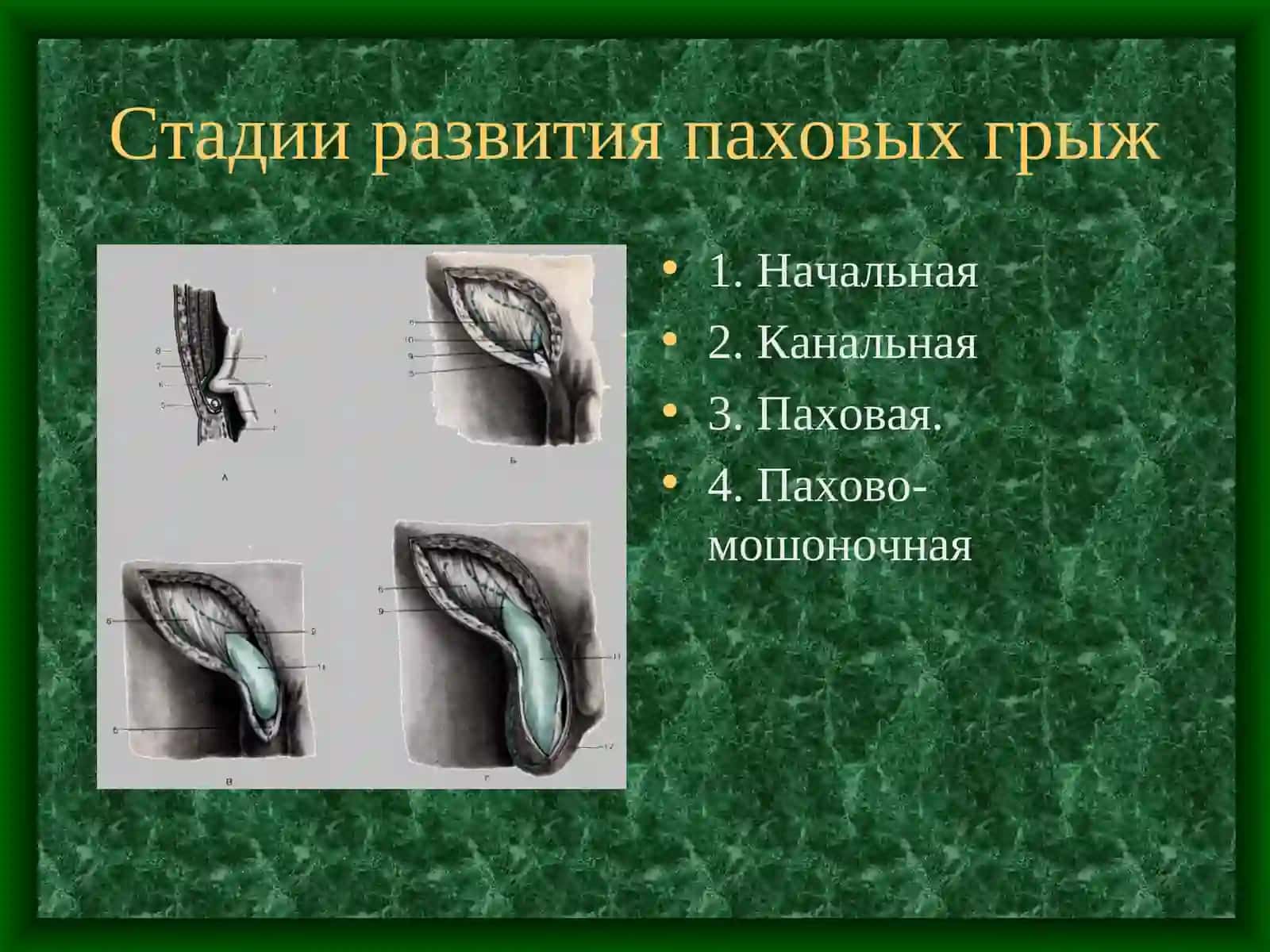 Классификация грыж 4