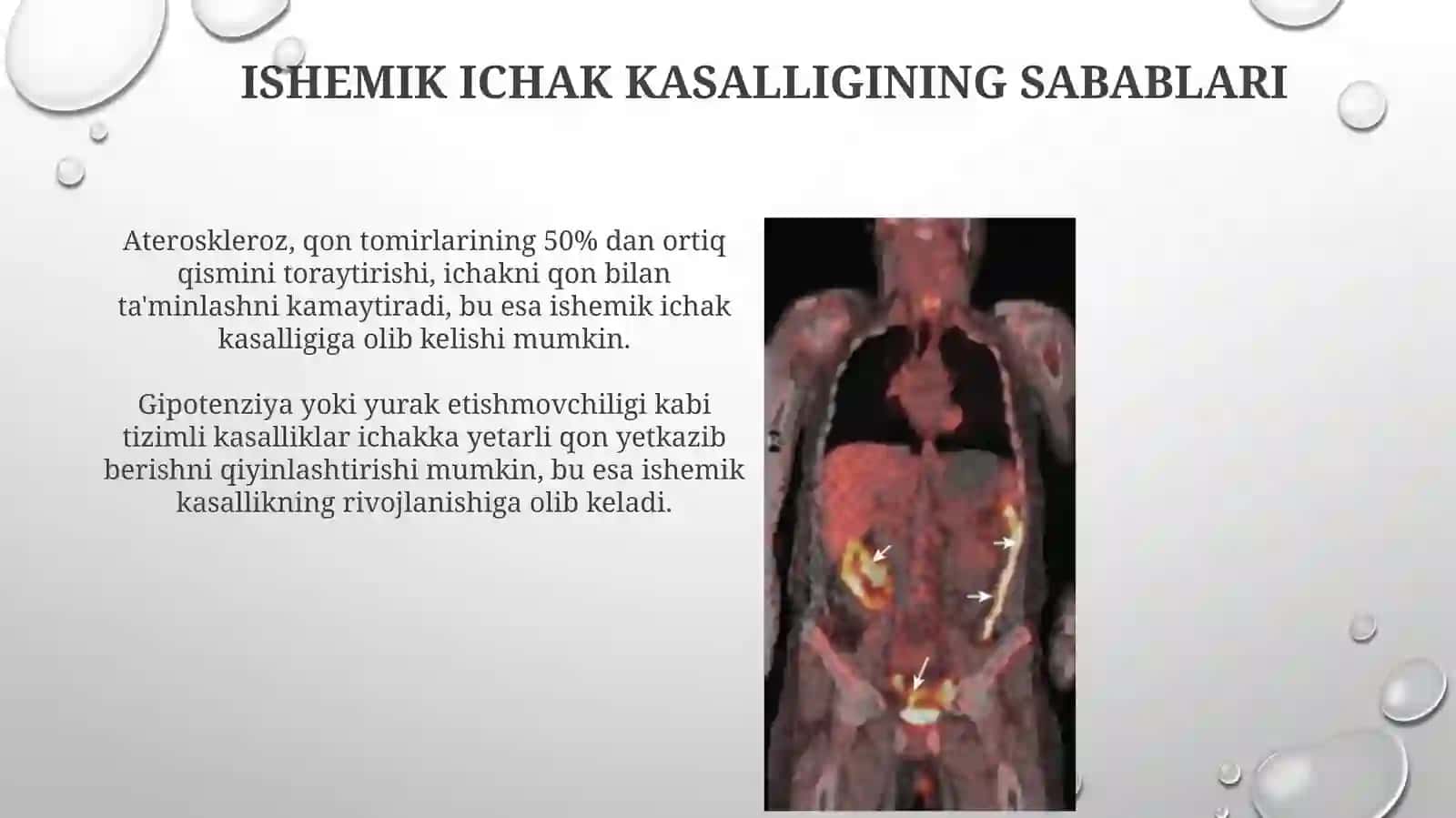 Ichakishemikkasalligi.malabsorbsiyavadiarreya 4