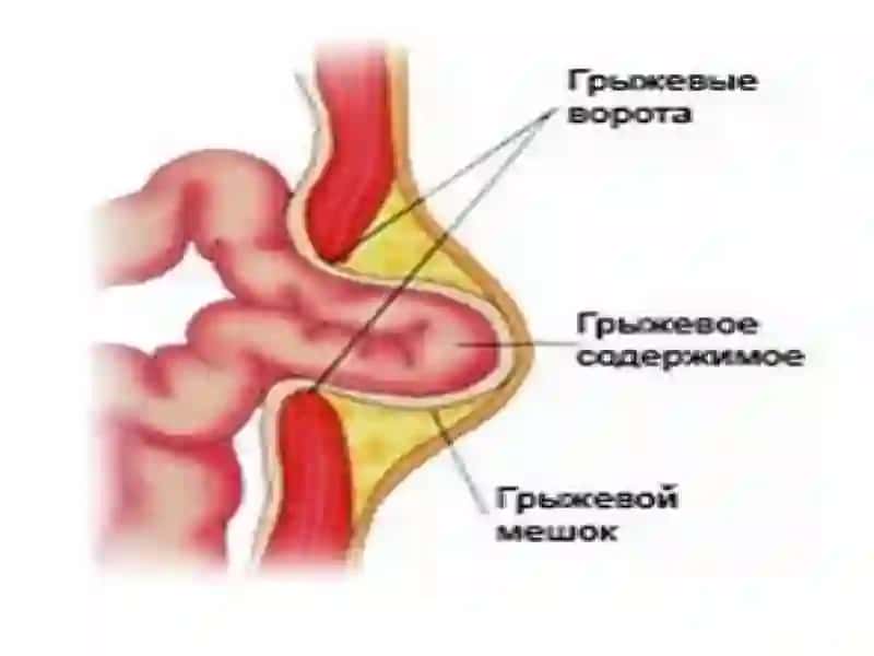 Qorin churrasi (churra abdominalis) 4
