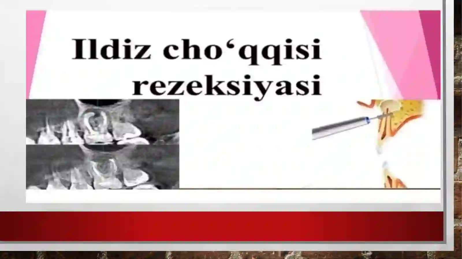 Periodontitni davolash pptx 4