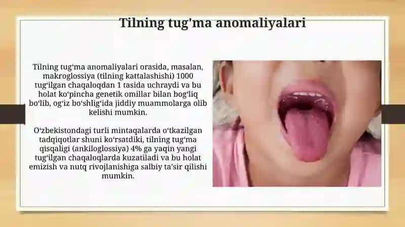 Tilning Og'riqlari (Glossodiniya) 4