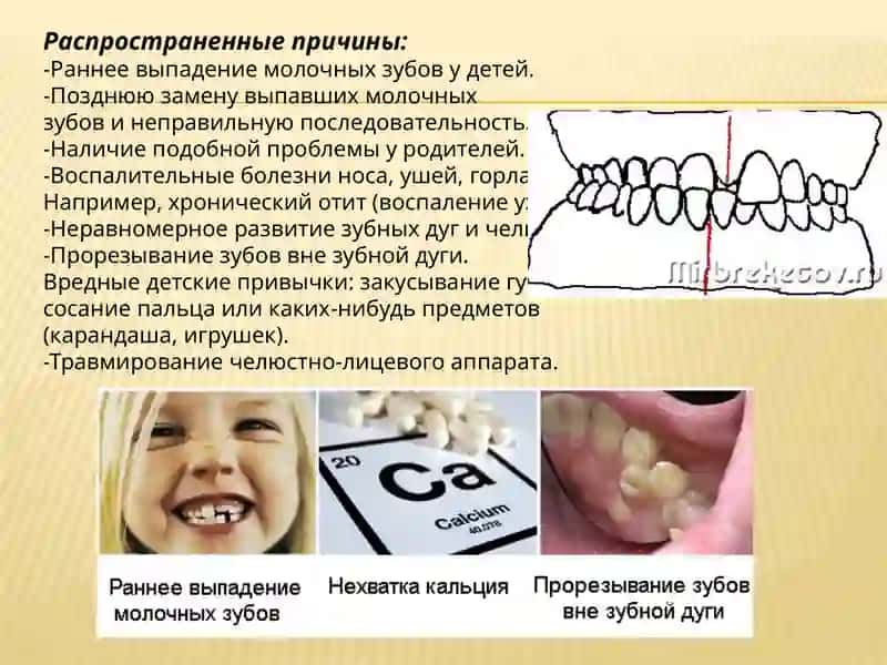Перекрестный прикус 4