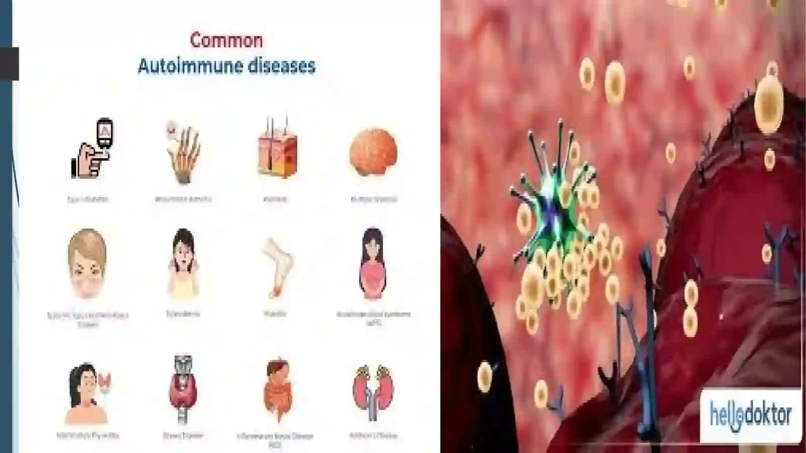Autoimmunkasalliklari 4