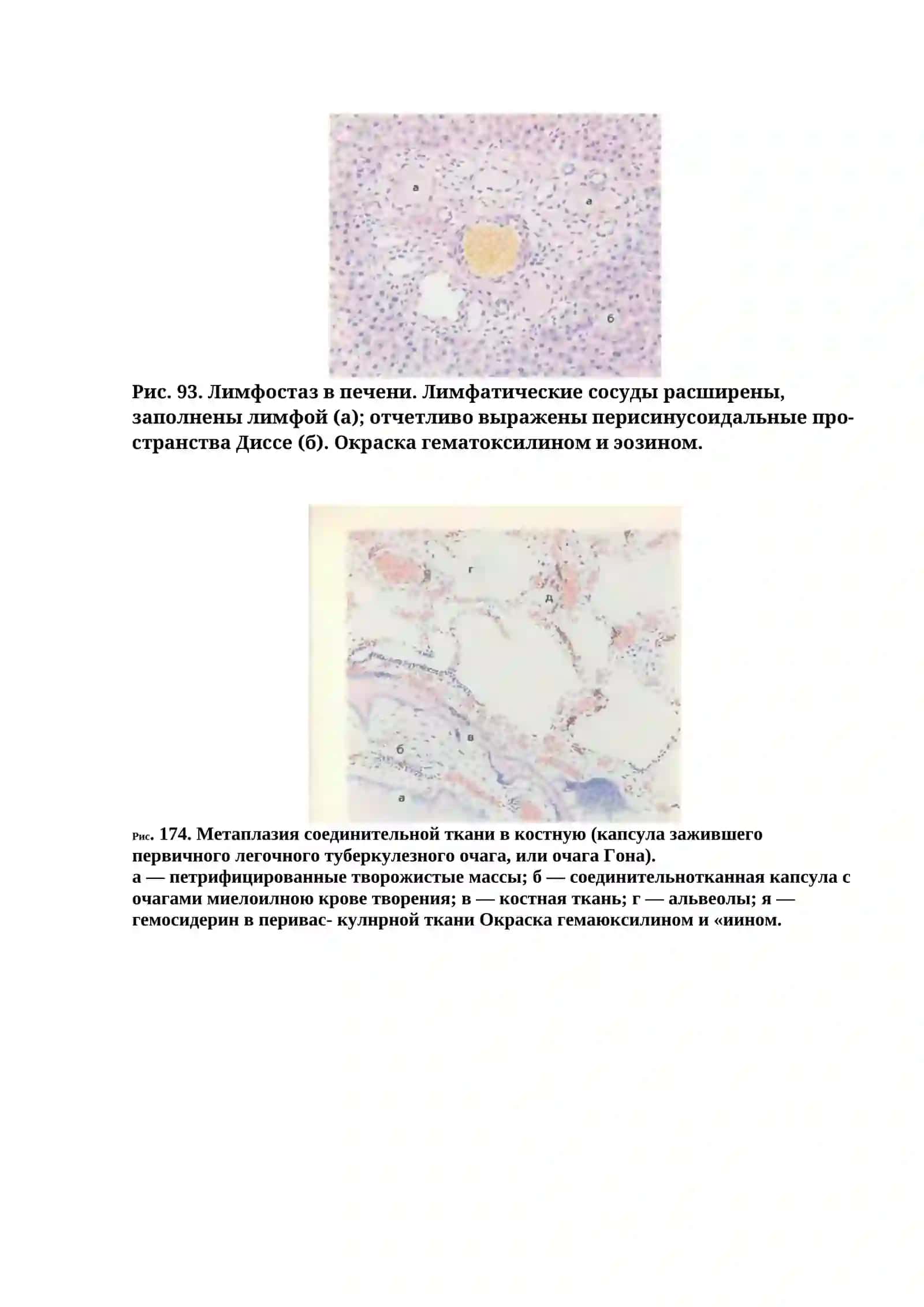 Атеросклероз аорты 4