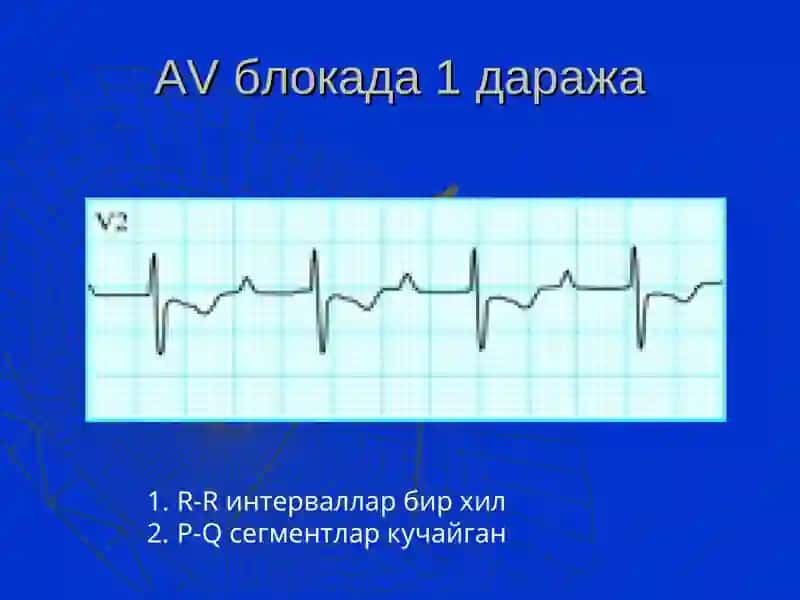 Болаларда аритмия 4