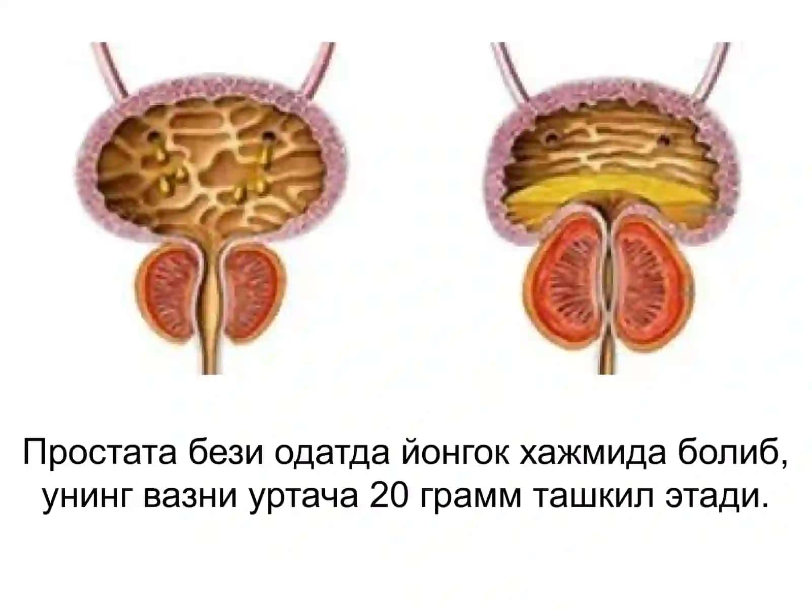 Простата бези хавфсиз гиперплазияси 4