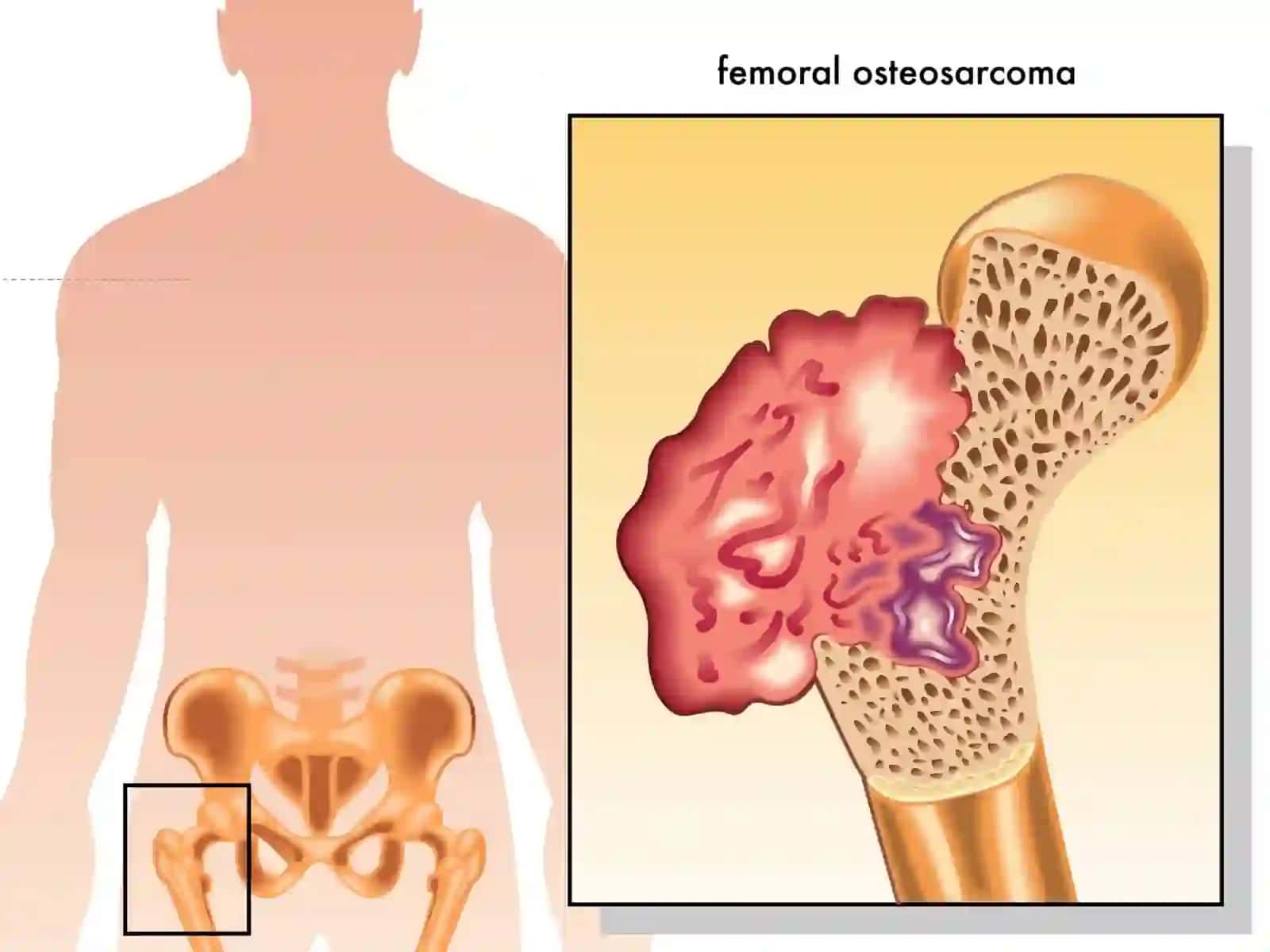 Suyak Xavfli O‘smalari: Osteogen Sarkoma va Ewing Sarkomasi 4