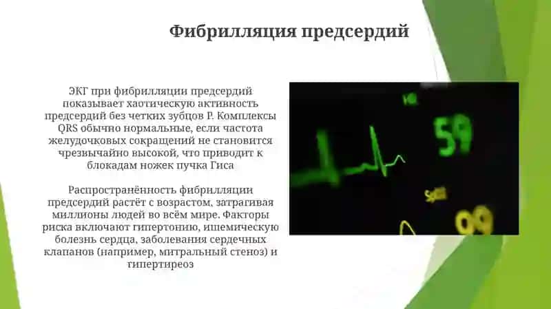 Блокировка ножек пучка Гиса 4