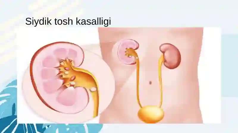 Tosh kasalligining kimyoviy asoslari 4